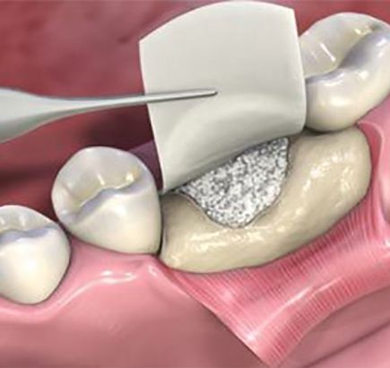 Biodegradowalna membrana do regeneracji kości przyzębia